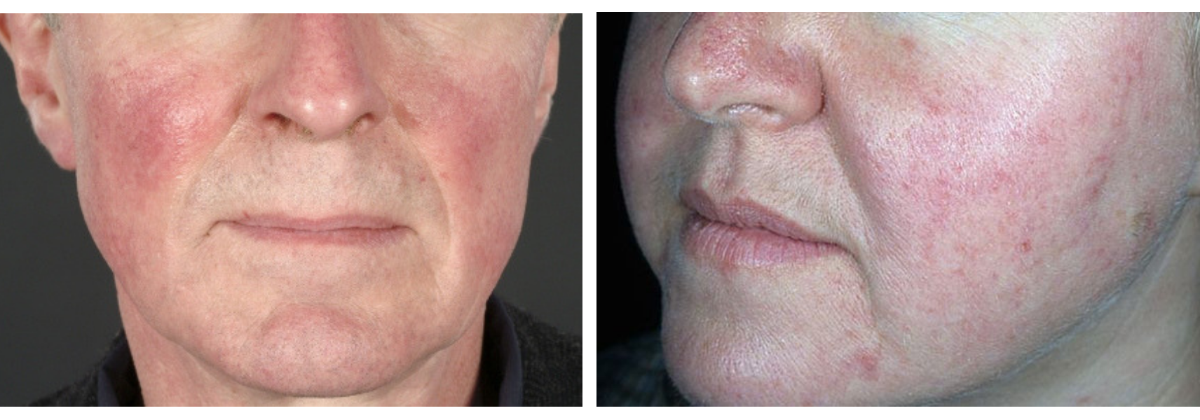 rosacea and redness treatment Victoria bc